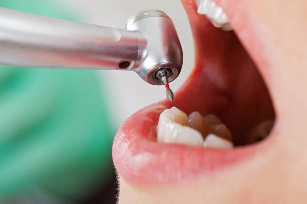 Best Chipped Tooth Repair Near Me  in Malvern, OH